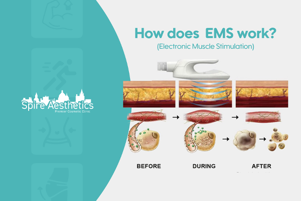 EMS treatment for post pregnancy weight loss treatment Bracknell