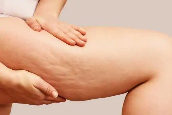Image of woman showing leg with cellulite Bracknell