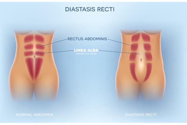 What Non-Surgical Options Are Available for Diastasis Recti Bracknell?