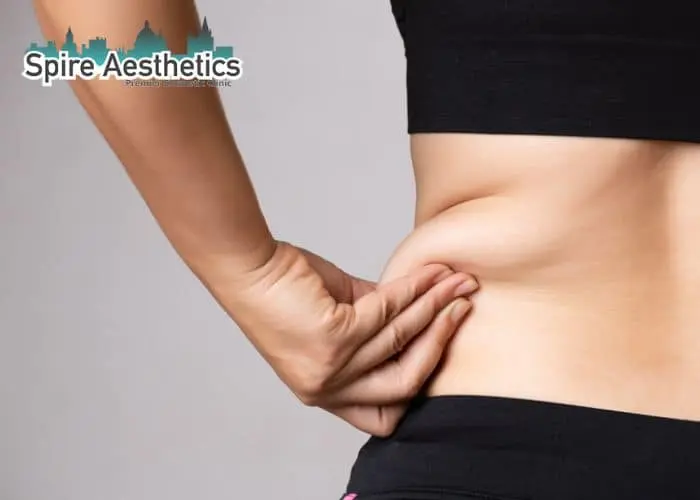 Image of woman pinching fat on their hips Bracknell. Fat Freezing treatment