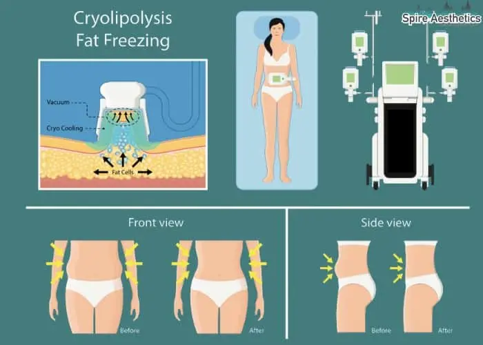 Fat freezing treatment Bracknell benefits for competitions to remove stubborn fat deposits.
