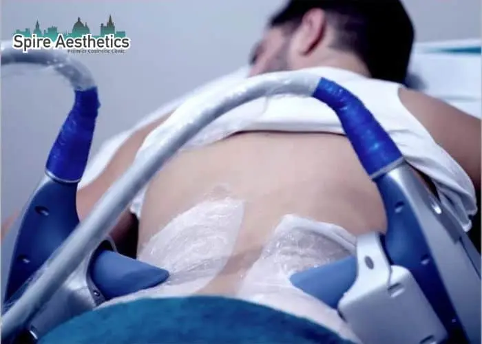Man having fat freezing treatment done on love handles before a competitions Bracknell to create a sculpted look.