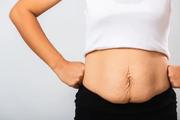 Image of a woman's stomach after weight loss with sagging skin following a gastric band Bracknell