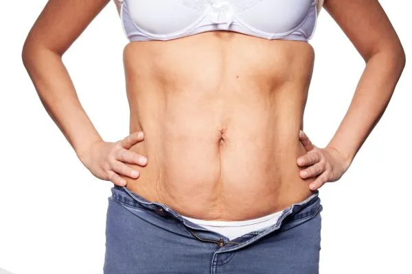 sagging skin on woman's stomach after weight loss injections Bracknell