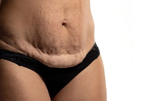 Image of womans stomach after weight loss injections Bracknell showing saggy skin