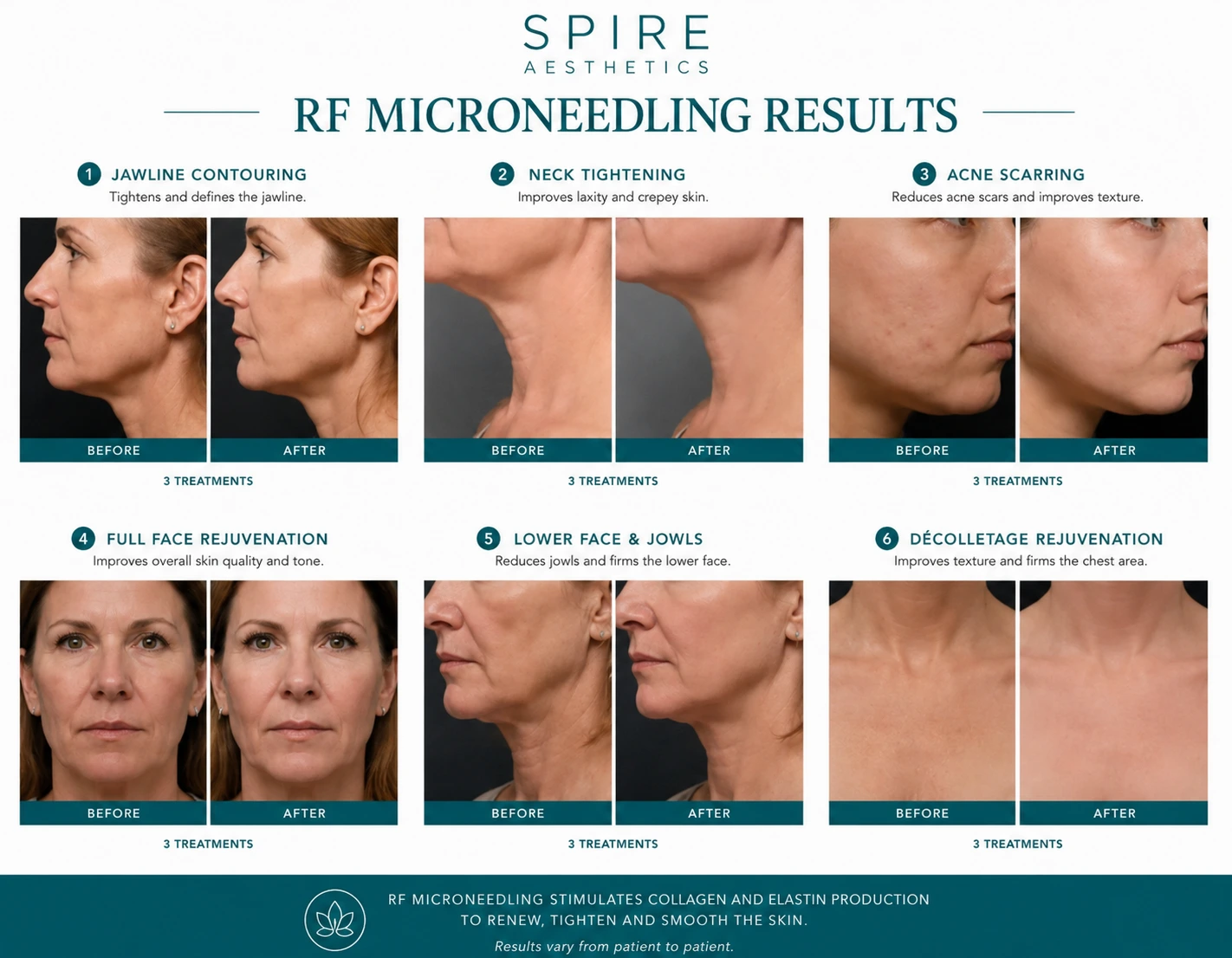 RF Microneedling Skin tightening Bracknell results