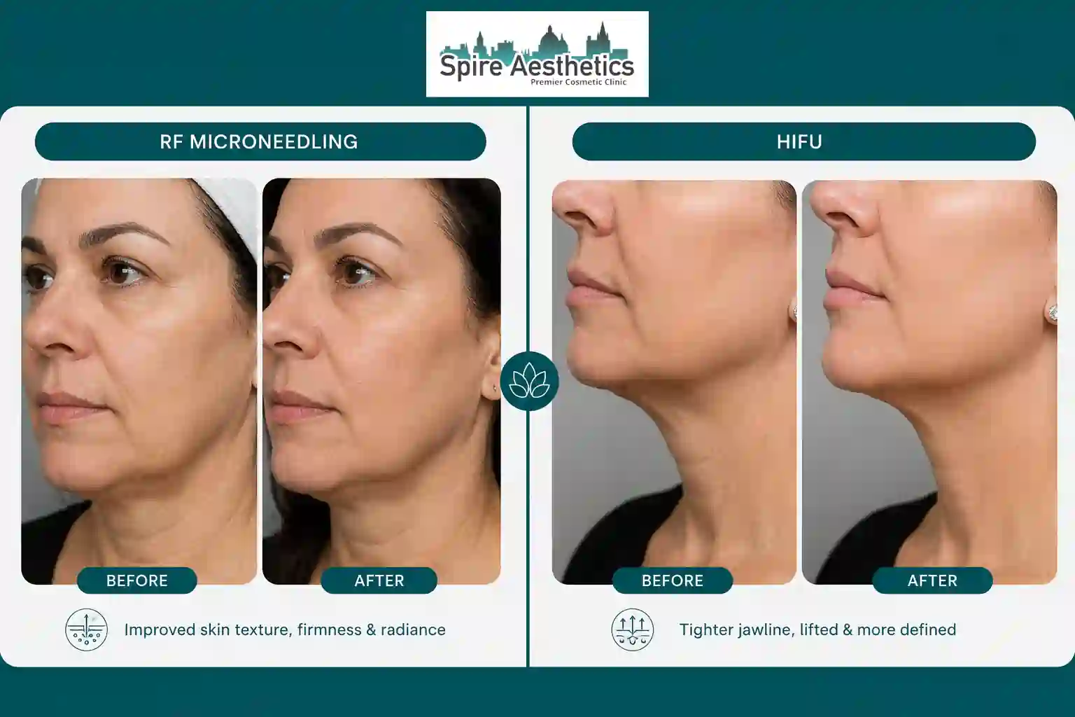 Can RF Microneedling and HIFU Be Combined Bracknell?