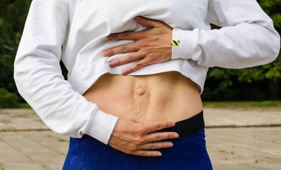 When Could Diastasis Recti Be the Missing Piece of the Puzzle Bracknell?