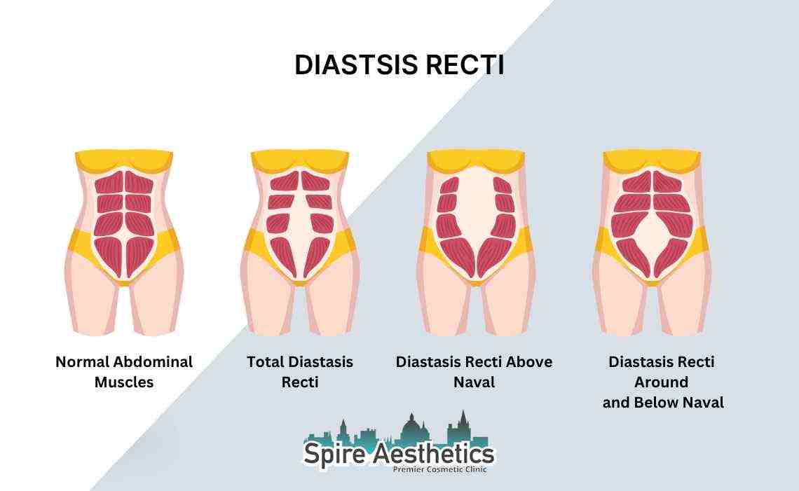 Is Non-Surgical Diastasis Recti Treatment Right for You? Common Concerns Answered Bracknell